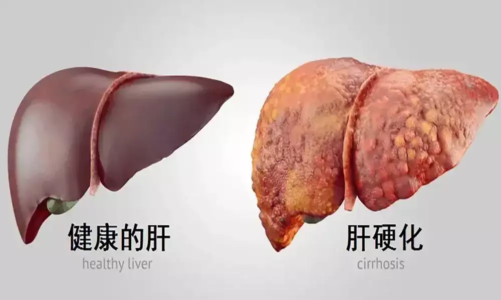 5. 损害肝功能