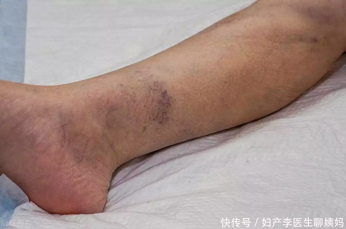 血管变窄是静悄悄的？提醒：腿上两个表现，暗示血栓正在进展