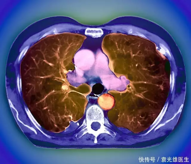 不抽烟，查出肺气肿？能自愈吗？做好4件事，让肺部更健康