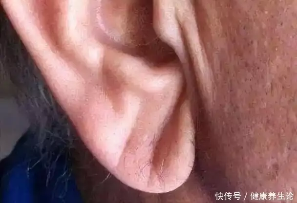 耳垂折痕，真的预示着心肌缺血？心脏病吗？看心血管医生怎么说！