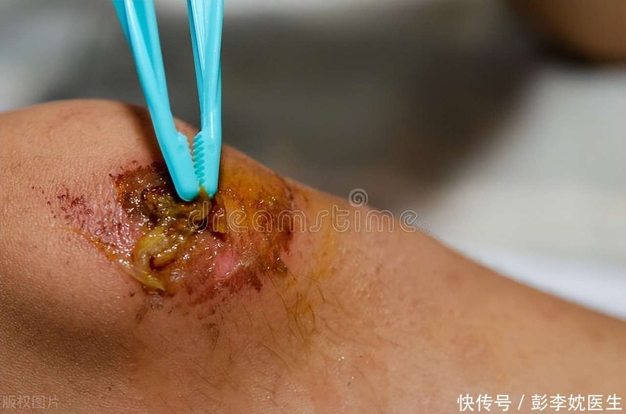 二、伤口愈合变慢