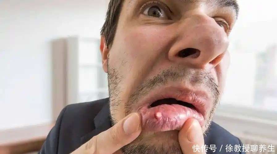 体内有癌,口知道?医生提醒:口腔显现3种迹象,或是癌入侵_【快资讯】