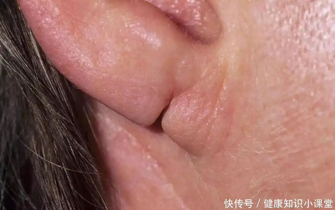耳垂上有折痕，就能看出心脏病？是真的还是谣言？