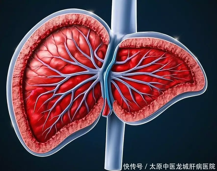 晋中脂肪肝检出率逐年升！你还以为是小毛病？5大致命并发症要警惕