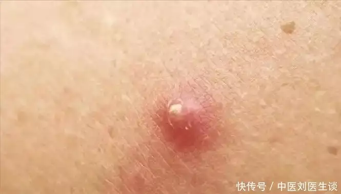 屁股总是长疙瘩和脓包，是怎么回事？能抠吗？医生告诉你答案