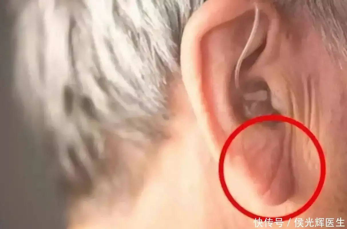 耳垂折痕，真的预示着心肌缺血？心脏病吗？看心血管医生怎么说！