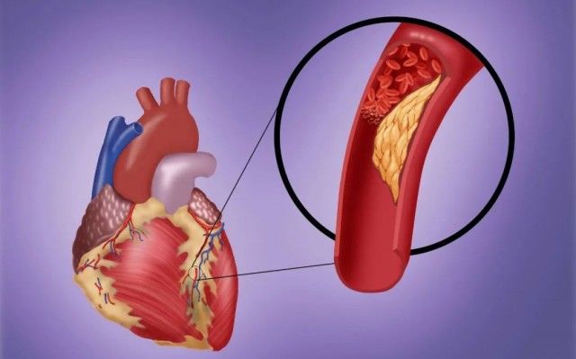 专家|一个公式预测“冠心病”风险，来自权威心脏病专家的推荐