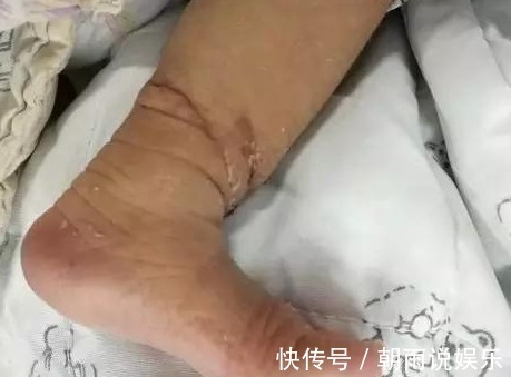 小晓|胎儿在妈妈肚子里腿被“绑绳”,孩子刚出生,医生可能要截肢