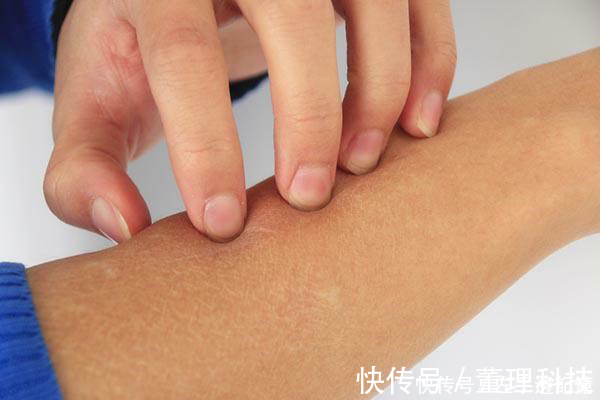 斑块|医生提醒大家,得了癌症,皮肤是会给出信号的,4点异常较为明显