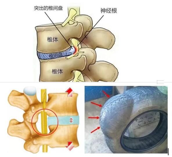 微创|微创局麻孔镜技术，快速解决腰椎间盘突出的疼痛烦恼