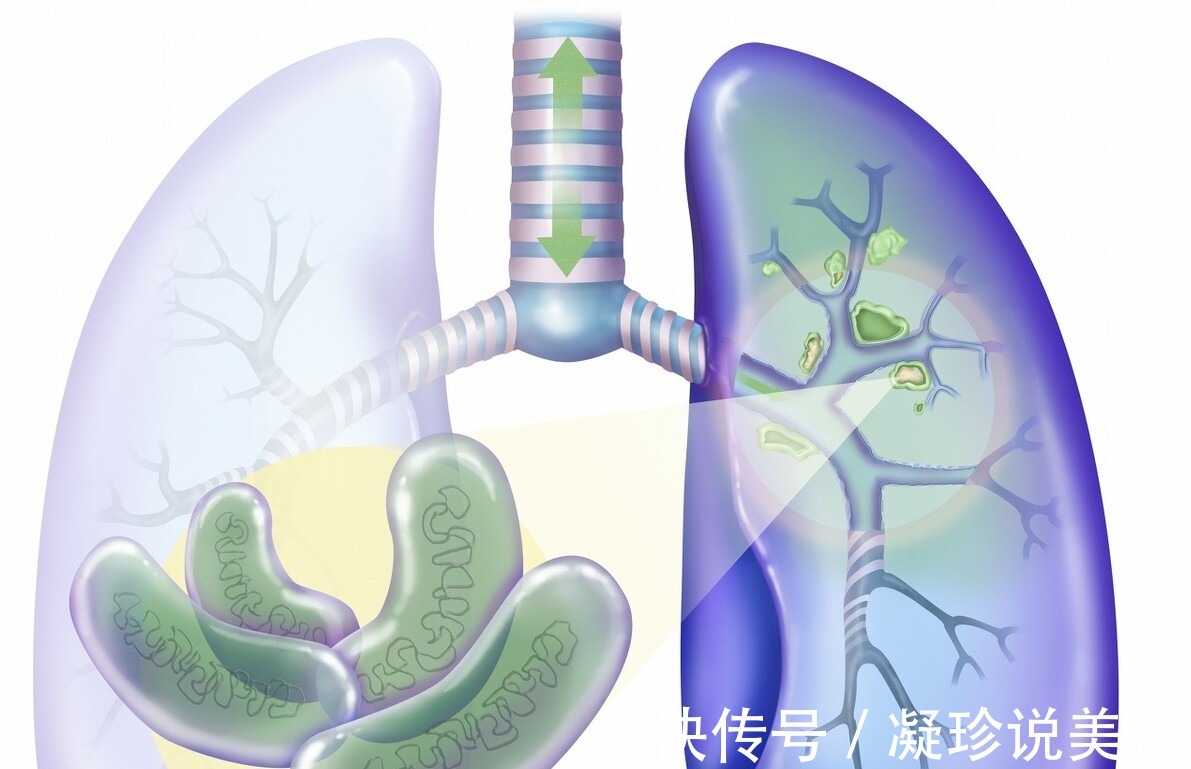 医生|女子咳嗽以为感冒，后天天咯血，医生看到鼻梁上的皮疹差点误诊