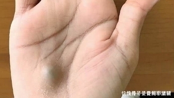 拔牙|男子医院拔出一颗牙，几乎拔掉了自己一条命