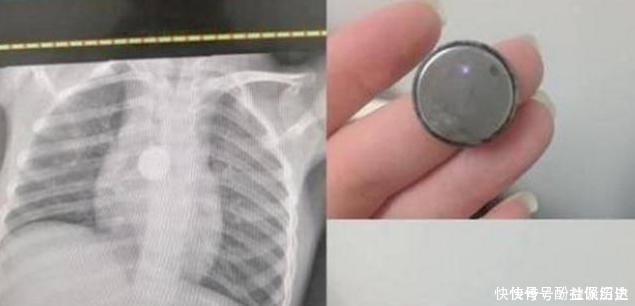 女儿突然暴瘦,拍片时医生让摘下项链,宝妈疑惑我女儿没戴项链