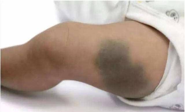 双胞胎姐姐“消失”在腹中,化为弟弟腿上的胎记