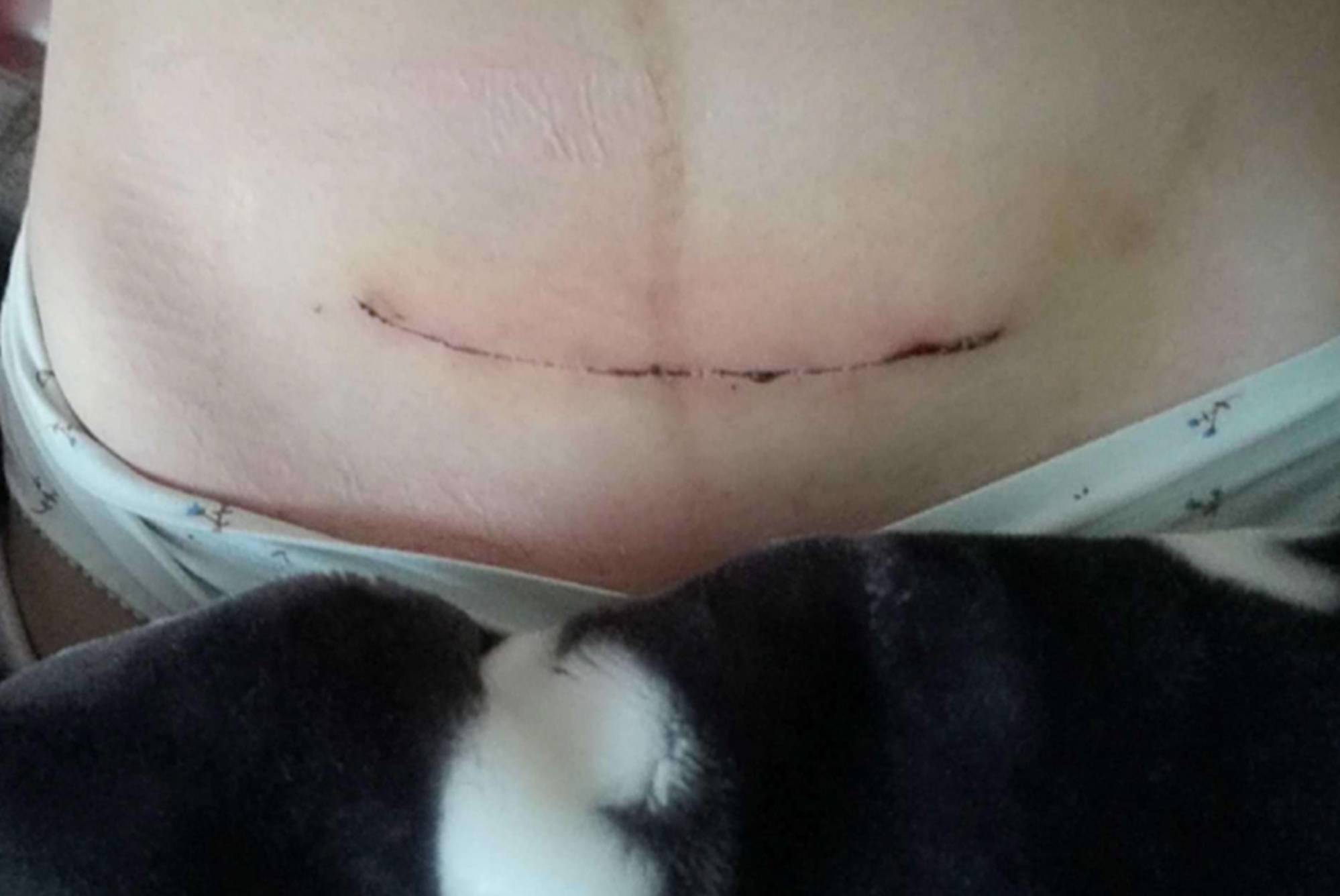 宝妈|“我没说要竖刀啊”,为什么剖腹产医院默认竖刀女性要提前了解