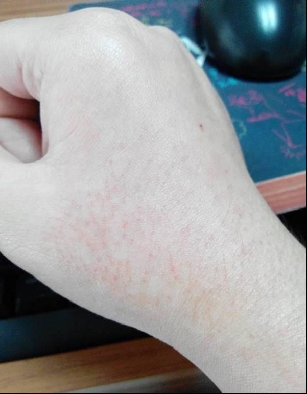 皮肤过敏|皮肤都很脆弱,过敏说来就来,远离它注意以下几点!