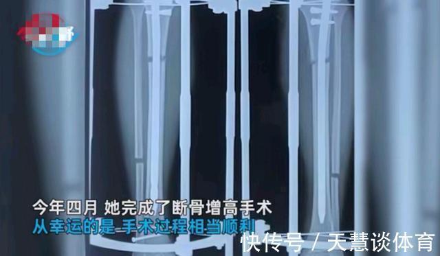 三份工 为了增高,她打三份工挣钱完成断骨增高手术,成功增高7cm
