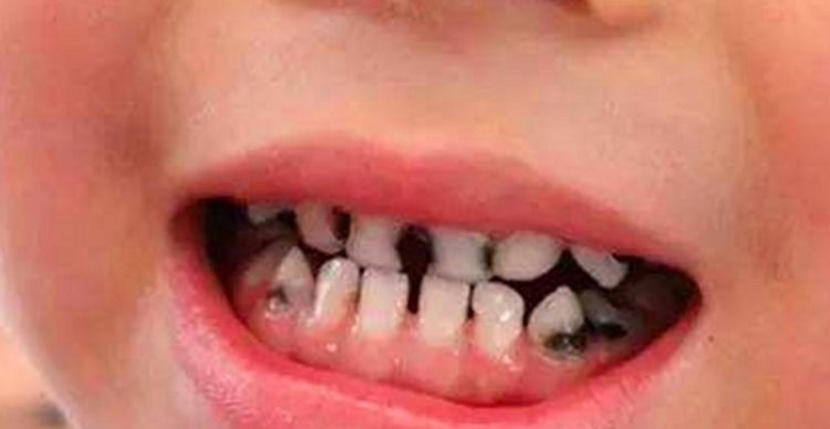 刷牙|7岁男孩长了“双排牙”,需要一颗一颗拔掉,奶奶:都怪我