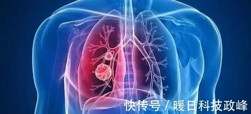 内分泌功能紊乱|46岁阿姨不痛不痒查出肺癌，医生：手上3种标记，已到中晚期