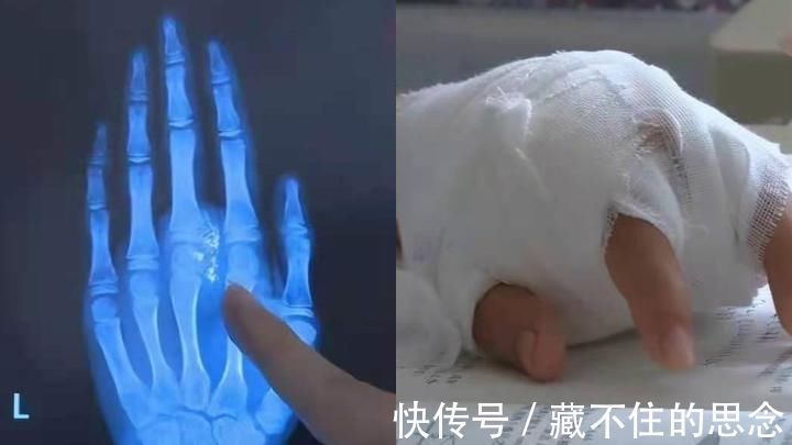 俊俊|别再用了！13岁男孩不小心弄断它，手肿成了馒头