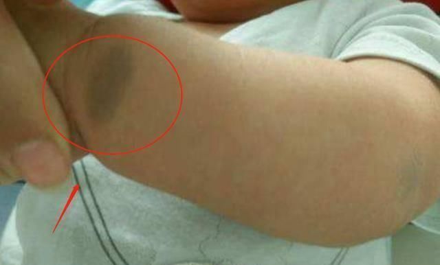 屁股|宝宝身上有淤青是来给父母报恩的如果胎记长成这样,家长要重视