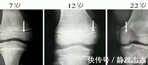 小玲|“娘矮矮一窝”有道理吗？跳出长高误区，抓住“生长要素”是关键