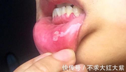 甲状腺|身上突然摸到肿块，就一定是得癌了？不同位置或暗示不同问题