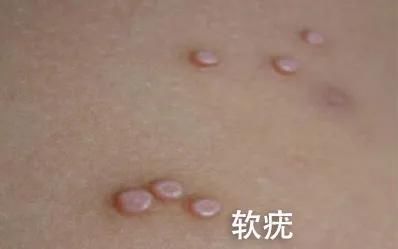 hpv|皮肤上长这种「小疙瘩」，可能和HPV感染有关……