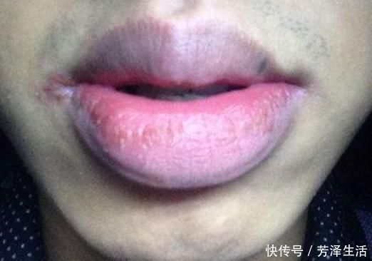肝不好嘴先知？无论男女，嘴上有3个预兆，肝硬化可能一触即发！