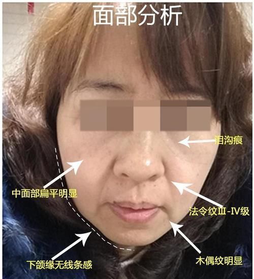 线雕6个月后脸仍旧凹凸不平,问题出在哪?还能救吗?