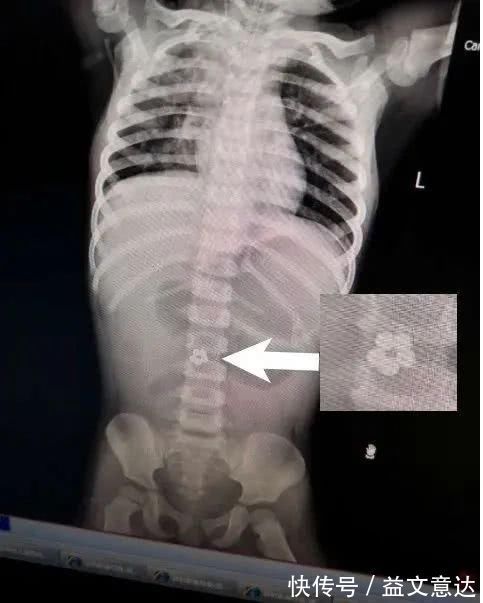 静静|家长注意这网红玩具千万别买,2岁娃因它进了ICU家里有的快扔掉