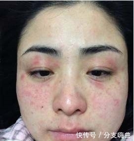 你粉|用不起神仙水还没耐心读懂这些“酸”,活该你粉刺闭口毛孔粗大!