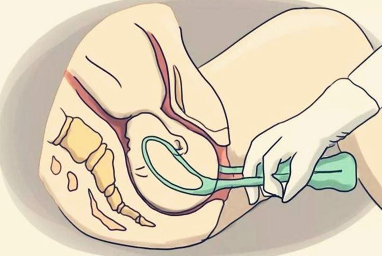 助产神器|生孩子时,产妇自己使劲儿就够了吗?不,三种“助产神器”有妙用