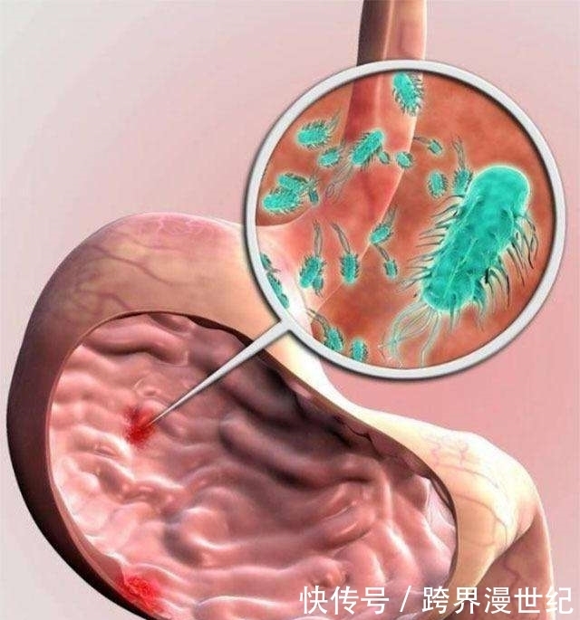 螺旋杆菌|藏在胃里幽门螺旋杆菌,怎么将他排出体外,我们可以这样做