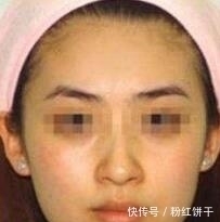 慢性肝炎|身体忽然出现两种痣,可能是你肝脏有问题,要及时排毒素了