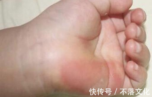 伤处|5岁孙子被开水烫伤,奶奶临危不乱及时处理,获医生称赞 !