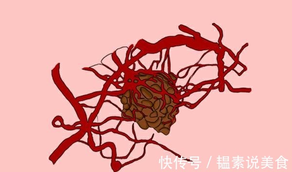 复发率|哪些癌症的术后复发率高医生全部列出来了，尽量记住吧