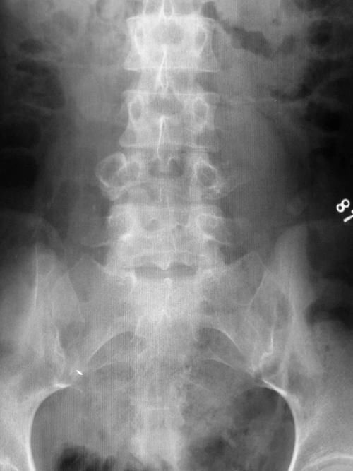椎体|脊柱常见肿瘤及肿瘤样病变的几种影像学表现，你都见过吗？