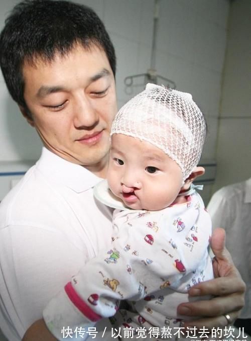 上唇腭裂|孕期胎儿频繁好动，孕妈以为孩子很健康，产检后医生：流产吧