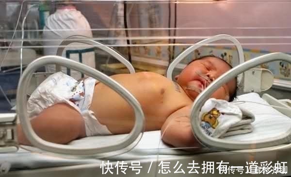糖尿病|41岁高龄产妇竟产下17斤巨婴, 巨宝宝胃口更是大得让人咂舌