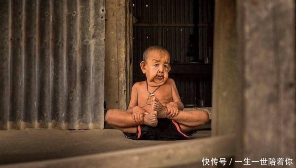 男孩|印度4岁男孩面容如90岁老翁,3个月大牙齿长全