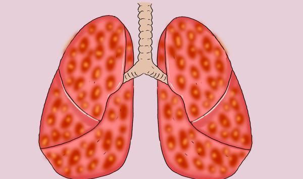  心理|07年查出肺癌晚期，现带癌生存17年，他分享了5条经验，值得借鉴