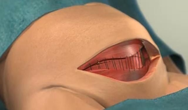 伤口|宝妈吐槽分娩时的尴尬:头胎顺产被“剃毛”,二胎剖腹产也没逃掉