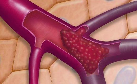 血细胞|人体上有个“化栓开关”,每天这样做,不花一分钱,还能防血栓!