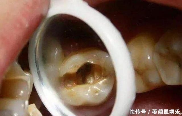 牙齿|家里这3样东西,比糖还容易让孩子长“黑牙”,家长别让孩子碰