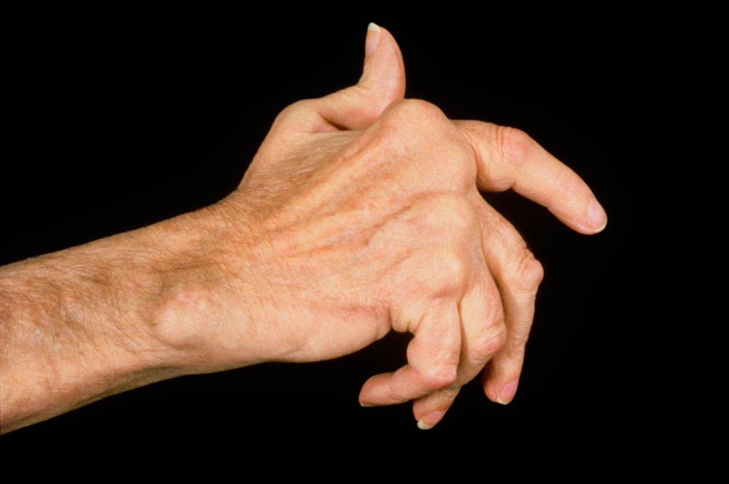 风邪|“类风湿性关节炎”的中医治法!教你3招逼出湿气,别再被坑了!