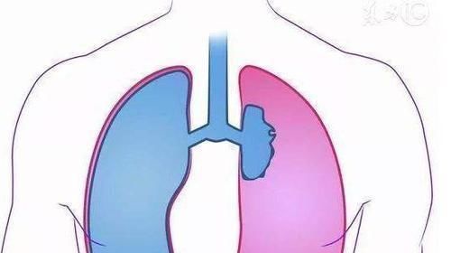就诊|肺癌早期也是有迹可循的,身体出现这5个异常,还请及时就诊检查!