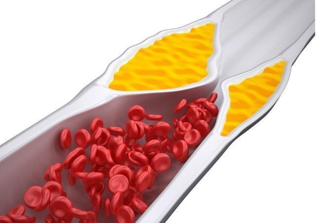 膳食纤维|血管不堵的人,早起会有3个异常,占了1个也要恭喜,血管还算健康