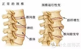 病变|颈椎病、脂肪肝,中年人需时刻警惕的2种危险疾病