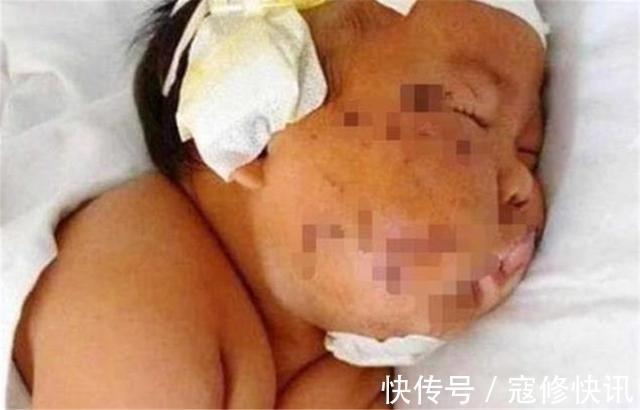 负面情绪|4年前,因吃奶咬疼妈妈,被妈妈用剪刀划伤脸的男婴,如今咋样了